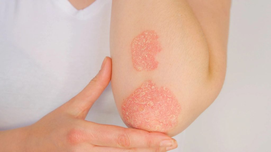 Treatment for Psoriasis