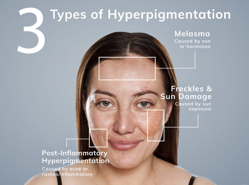 Types of hyperpigmentation